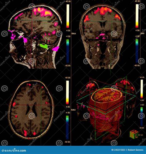 Risonanza magnetica funzionale del cervello